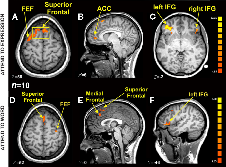 Contains 6 images of fMRI scans of the brain from differing orientations. Image description linked to in caption.