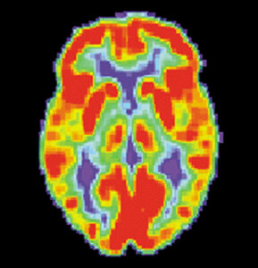 An image of a PET scan of the brain.
